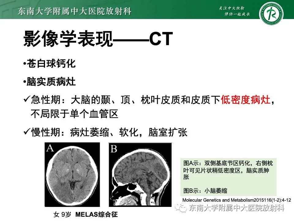 影像PPT - 【PPT】线粒体脑肌病伴高乳酸血症和卒中样发作-18