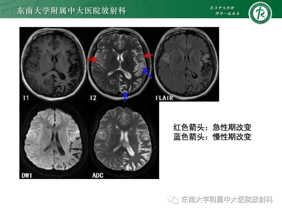 影像PPT - 【PPT】线粒体脑肌病伴高乳酸血症和卒中样发作-20