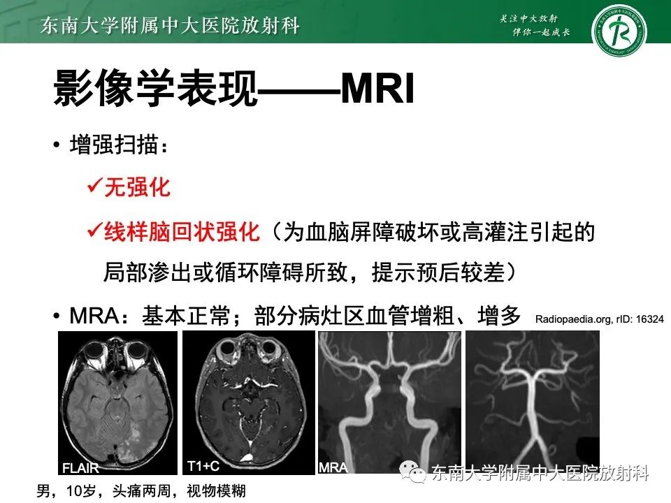 影像PPT - 【PPT】线粒体脑肌病伴高乳酸血症和卒中样发作-21