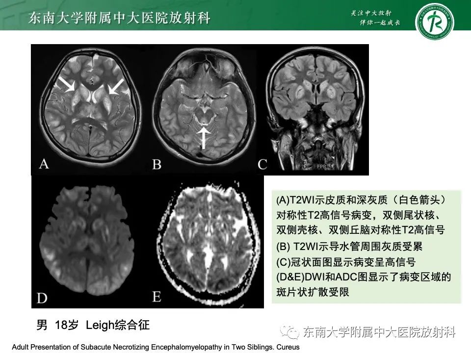影像PPT - 【PPT】线粒体脑肌病伴高乳酸血症和卒中样发作-27