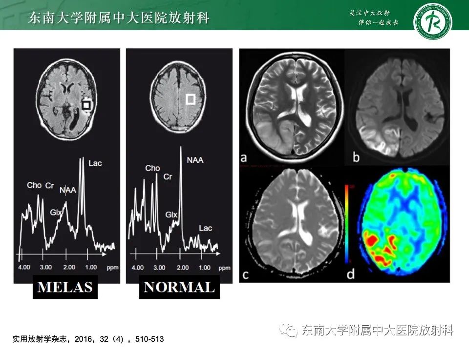 影像PPT - 【PPT】线粒体脑肌病伴高乳酸血症和卒中样发作-24
