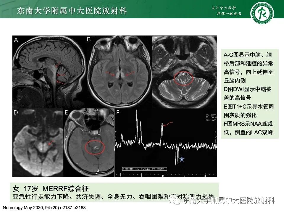 影像PPT - 【PPT】线粒体脑肌病伴高乳酸血症和卒中样发作-29