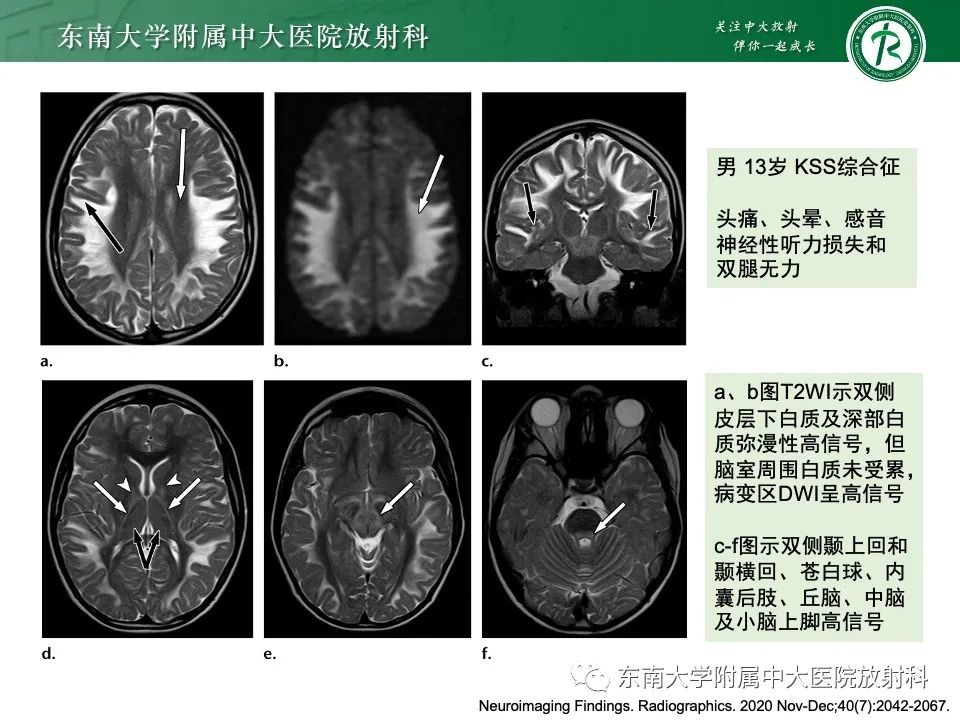 影像PPT - 【PPT】线粒体脑肌病伴高乳酸血症和卒中样发作-31
