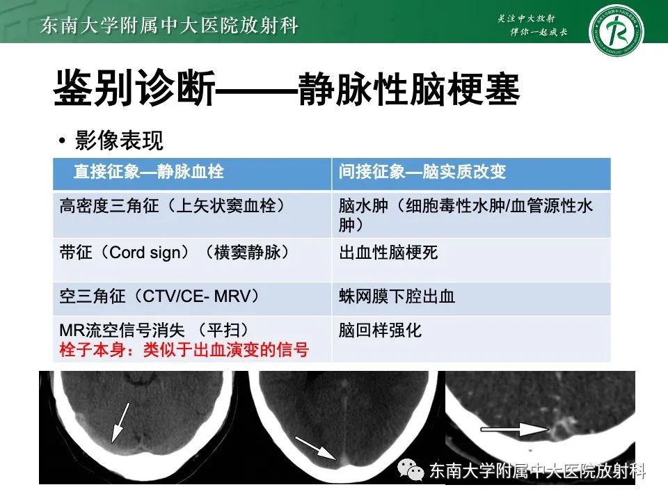 影像PPT - 【PPT】线粒体脑肌病伴高乳酸血症和卒中样发作-36