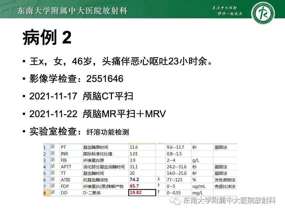 影像PPT - 【PPT】线粒体脑肌病伴高乳酸血症和卒中样发作-37