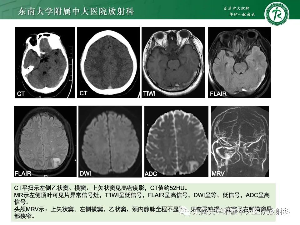 影像PPT - 【PPT】线粒体脑肌病伴高乳酸血症和卒中样发作-38