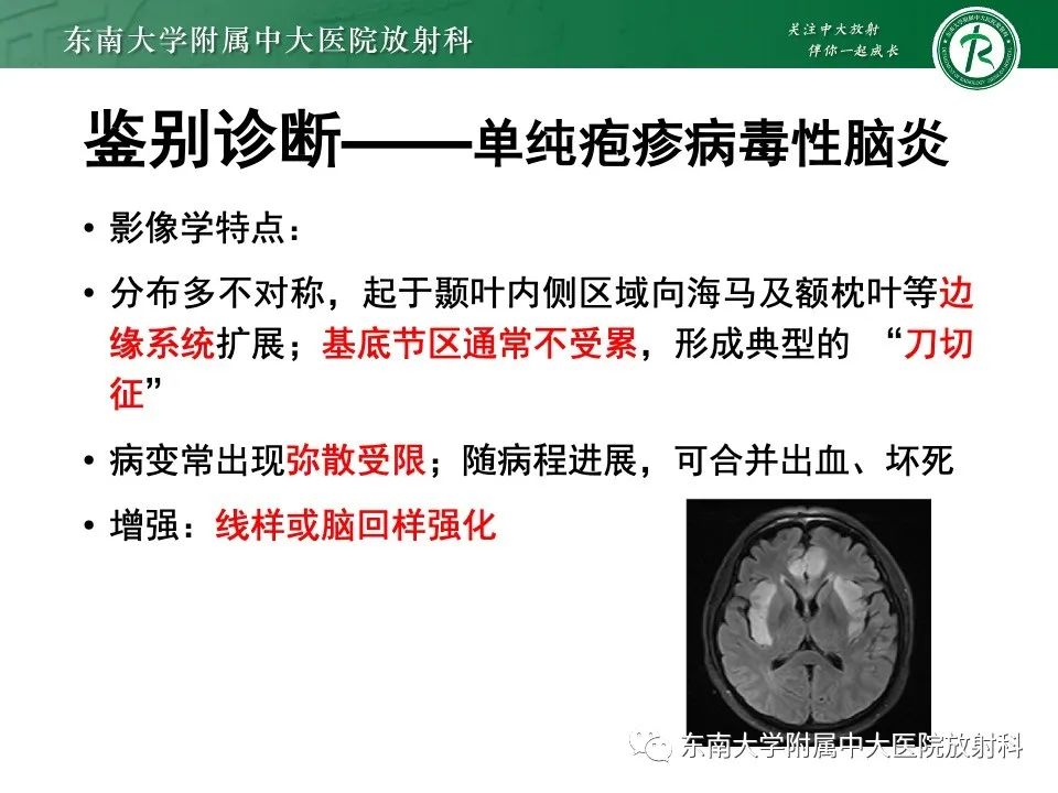 影像PPT - 【PPT】线粒体脑肌病伴高乳酸血症和卒中样发作-43