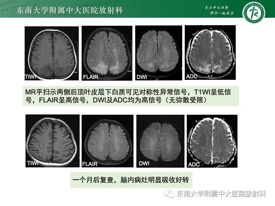 影像PPT - 【PPT】线粒体脑肌病伴高乳酸血症和卒中样发作-41