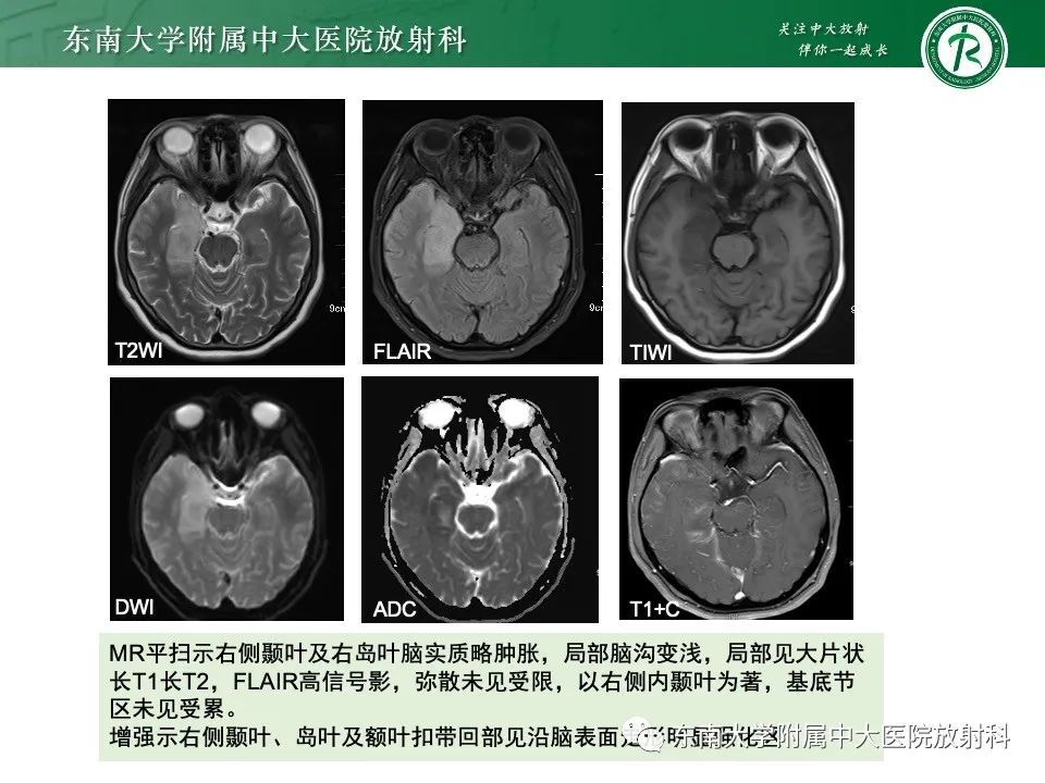影像PPT - 【PPT】线粒体脑肌病伴高乳酸血症和卒中样发作-45