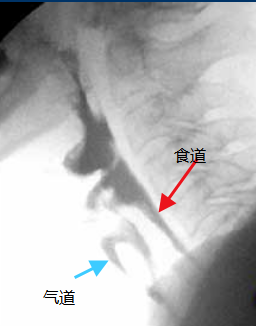 影像PPT - 吞咽功能障碍正常解剖及影像-8 影像PPT - 吞咽功能障碍正常解剖及影像-8
