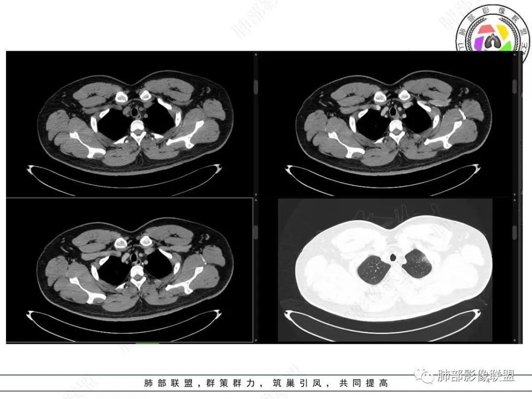 影像PPT - 【病例】左上胸骨外尤文氏肉瘤1例CT影像-4 影像PPT - 【病例】左上胸骨外尤文氏肉瘤1例CT影像-4