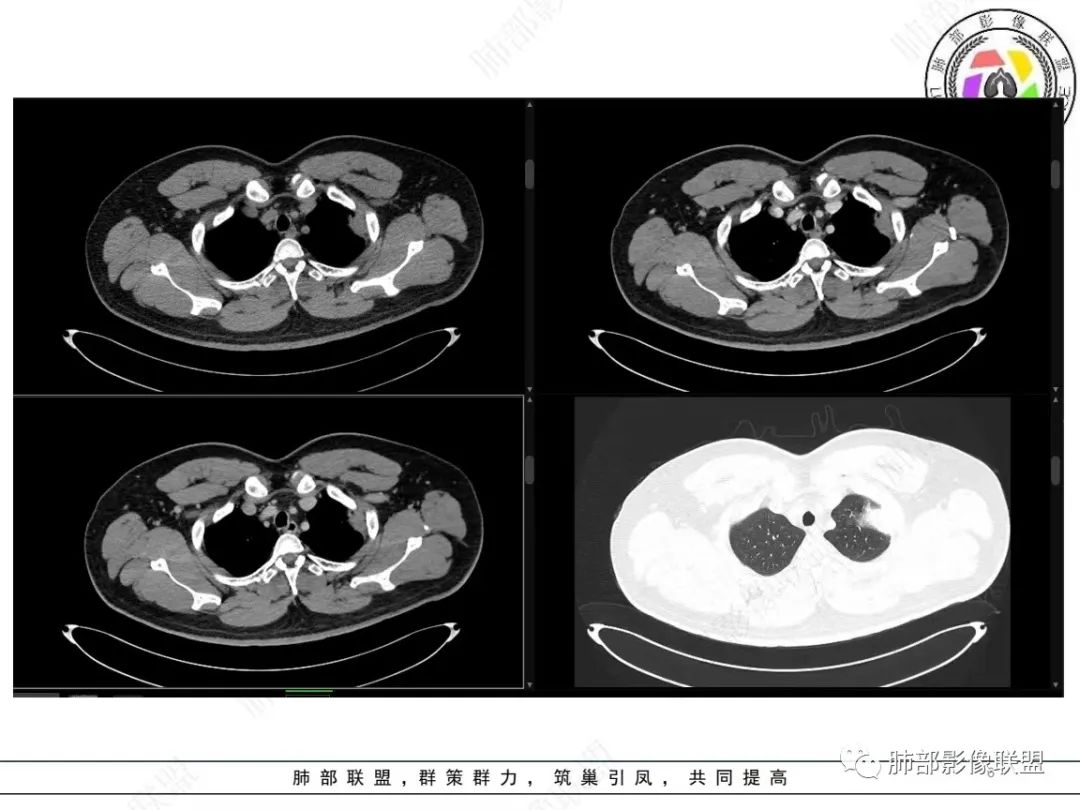 影像PPT - 【病例】左上胸骨外尤文氏肉瘤1例CT影像-6 影像PPT - 【病例】左上胸骨外尤文氏肉瘤1例CT影像-6