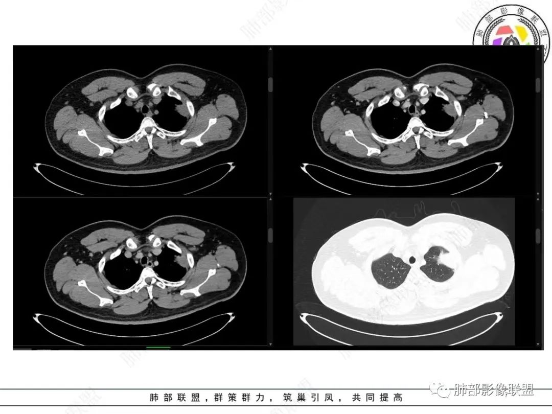 影像PPT - 【病例】左上胸骨外尤文氏肉瘤1例CT影像-7 影像PPT - 【病例】左上胸骨外尤文氏肉瘤1例CT影像-7
