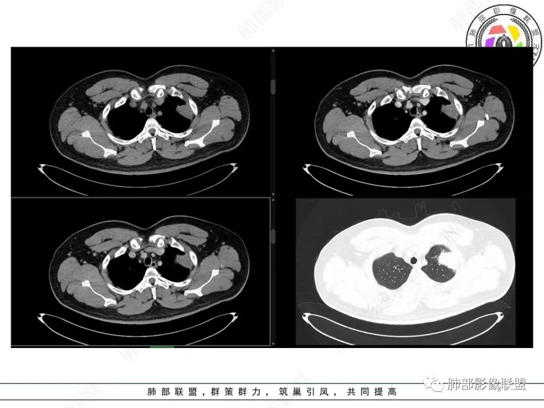 影像PPT - 【病例】左上胸骨外尤文氏肉瘤1例CT影像-8 影像PPT - 【病例】左上胸骨外尤文氏肉瘤1例CT影像-8