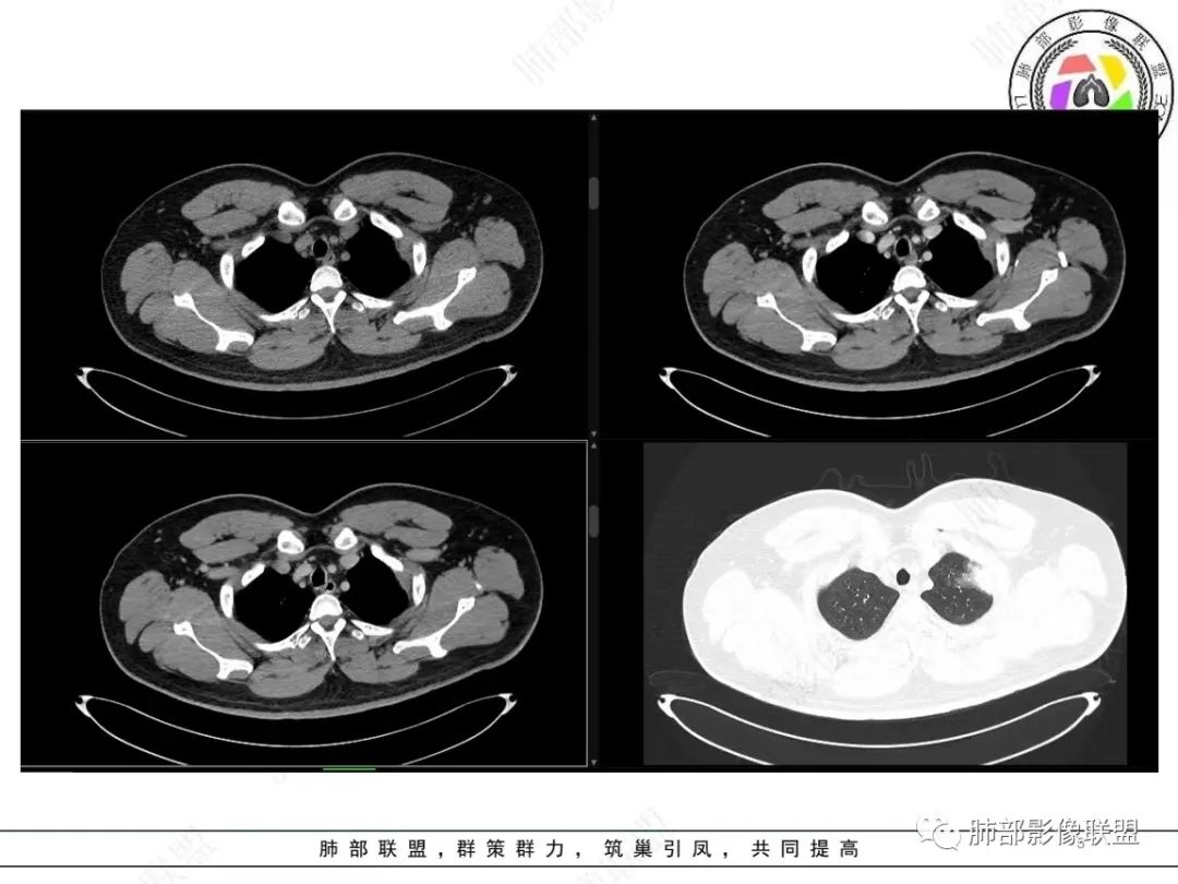 影像PPT - 【病例】左上胸骨外尤文氏肉瘤1例CT影像-5 影像PPT - 【病例】左上胸骨外尤文氏肉瘤1例CT影像-5