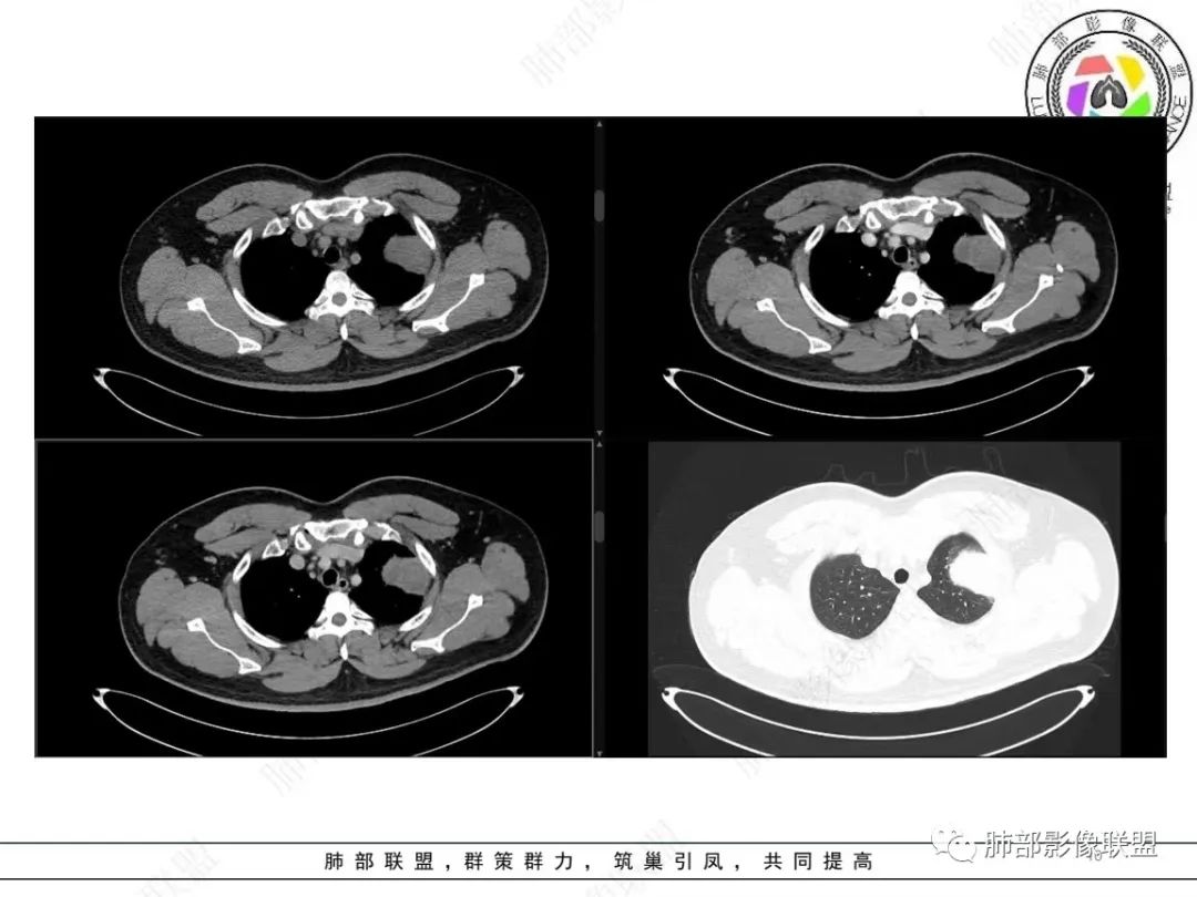 影像PPT - 【病例】左上胸骨外尤文氏肉瘤1例CT影像-10 影像PPT - 【病例】左上胸骨外尤文氏肉瘤1例CT影像-10