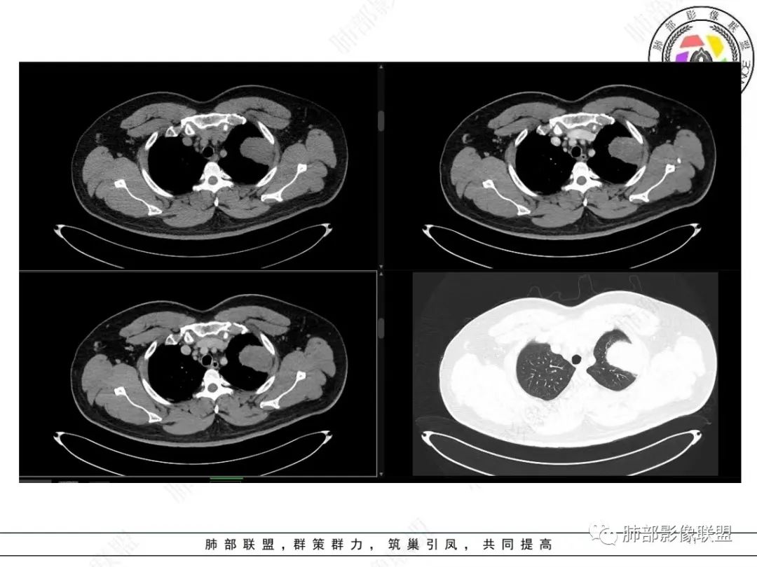 影像PPT - 【病例】左上胸骨外尤文氏肉瘤1例CT影像-11 影像PPT - 【病例】左上胸骨外尤文氏肉瘤1例CT影像-11
