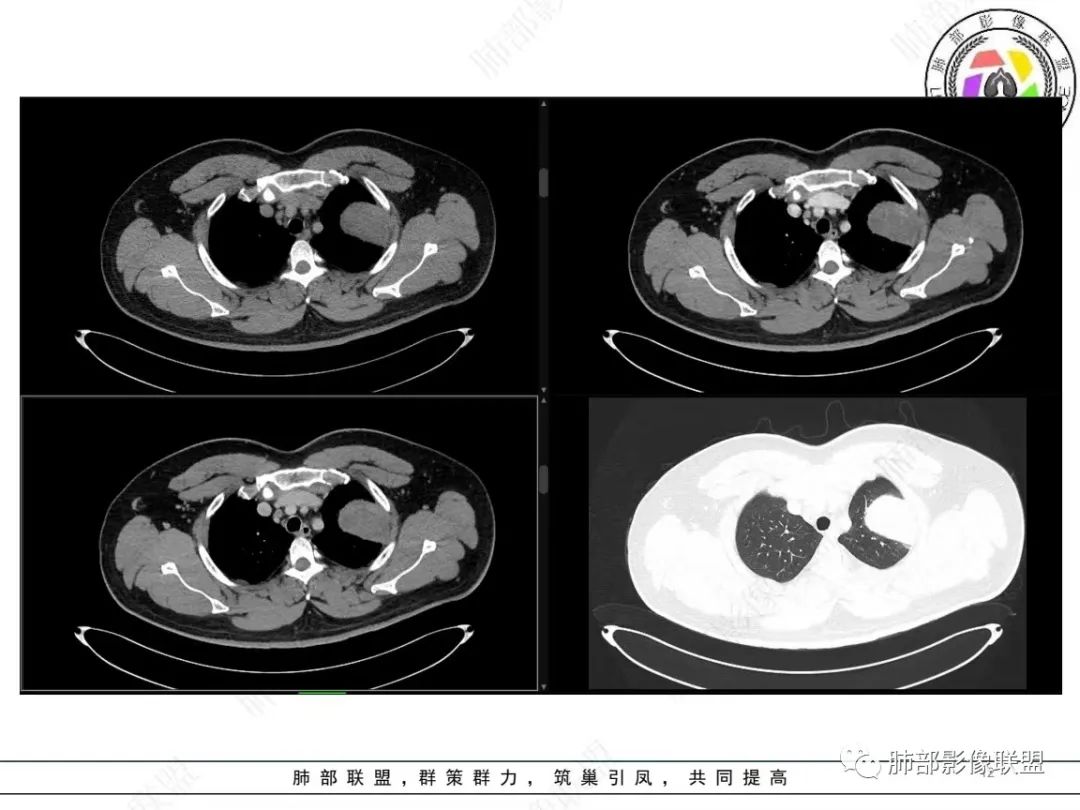影像PPT - 【病例】左上胸骨外尤文氏肉瘤1例CT影像-12 影像PPT - 【病例】左上胸骨外尤文氏肉瘤1例CT影像-12