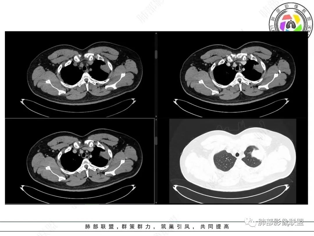 影像PPT - 【病例】左上胸骨外尤文氏肉瘤1例CT影像-9 影像PPT - 【病例】左上胸骨外尤文氏肉瘤1例CT影像-9
