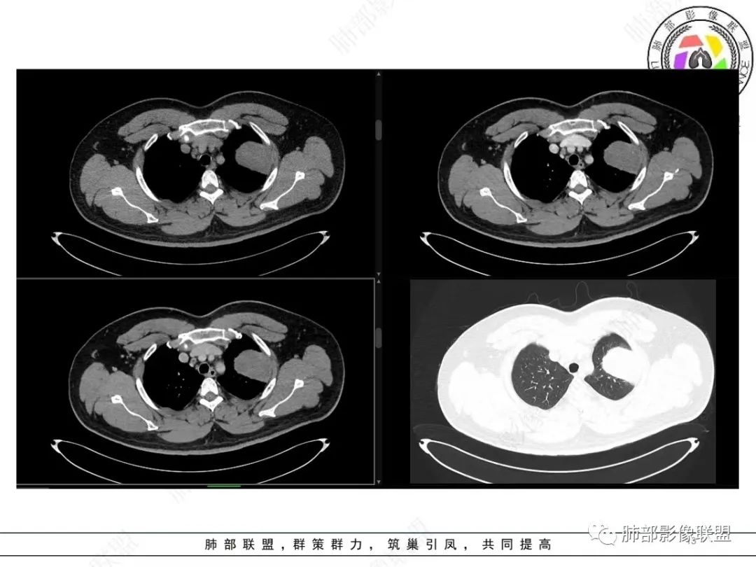 影像PPT - 【病例】左上胸骨外尤文氏肉瘤1例CT影像-13 影像PPT - 【病例】左上胸骨外尤文氏肉瘤1例CT影像-13