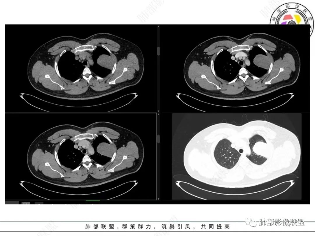 影像PPT - 【病例】左上胸骨外尤文氏肉瘤1例CT影像-14 影像PPT - 【病例】左上胸骨外尤文氏肉瘤1例CT影像-14