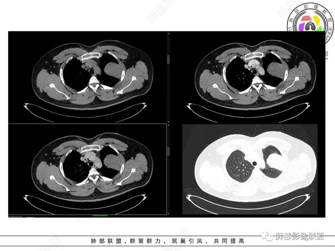 影像PPT - 【病例】左上胸骨外尤文氏肉瘤1例CT影像-15 影像PPT - 【病例】左上胸骨外尤文氏肉瘤1例CT影像-15