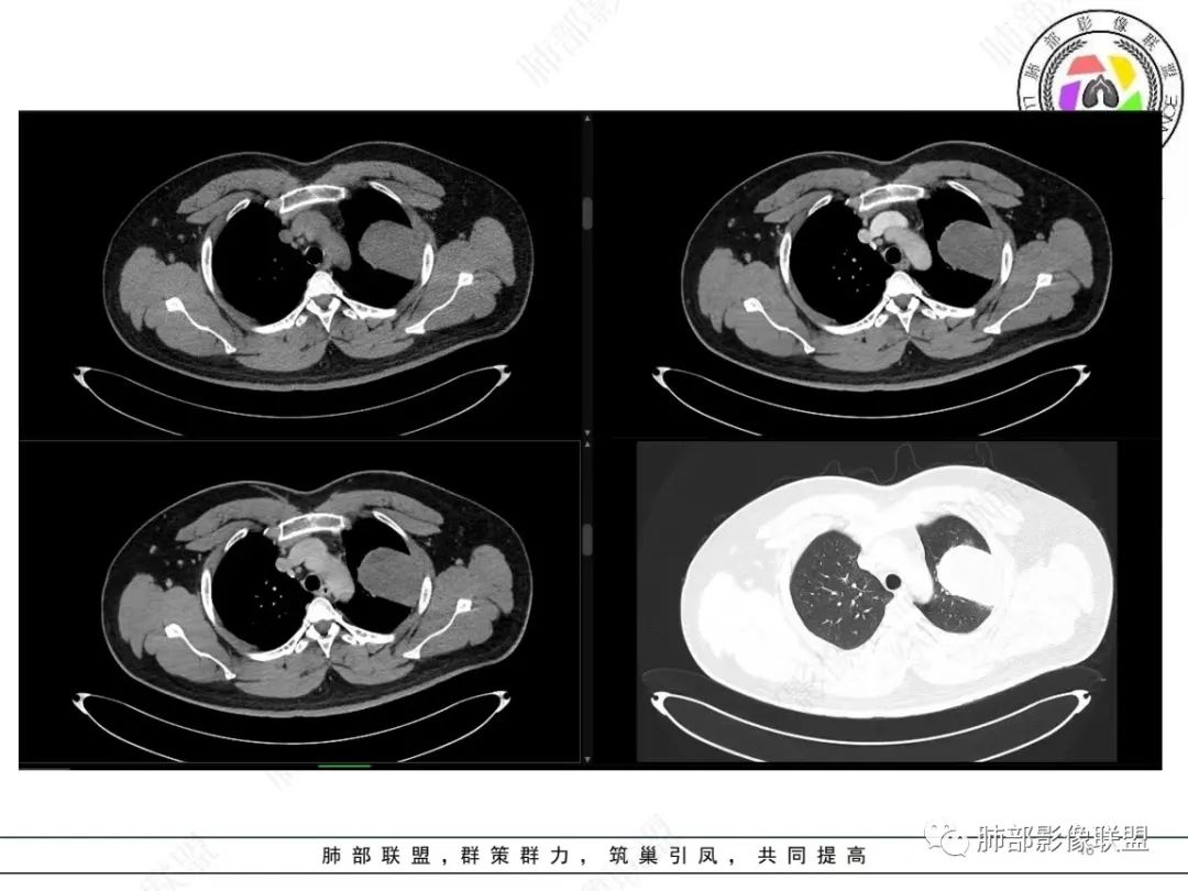 影像PPT - 【病例】左上胸骨外尤文氏肉瘤1例CT影像-16 影像PPT - 【病例】左上胸骨外尤文氏肉瘤1例CT影像-16