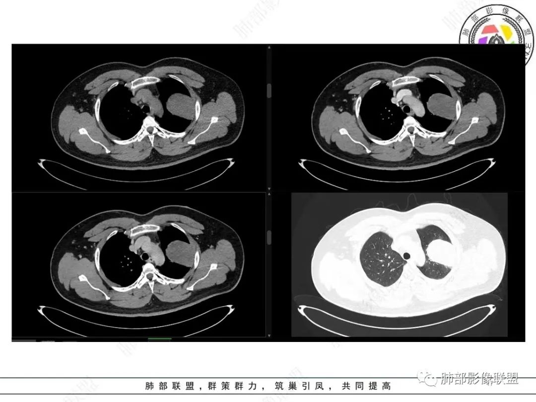 影像PPT - 【病例】左上胸骨外尤文氏肉瘤1例CT影像-18 影像PPT - 【病例】左上胸骨外尤文氏肉瘤1例CT影像-18