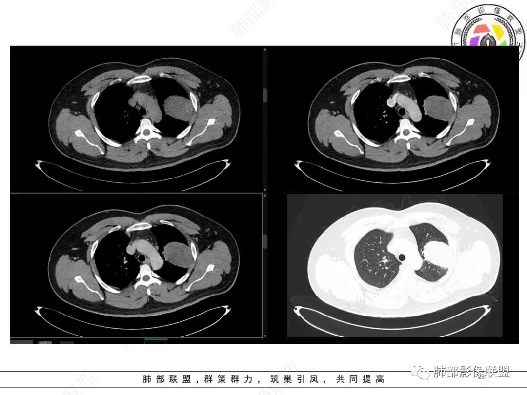 影像PPT - 【病例】左上胸骨外尤文氏肉瘤1例CT影像-19 影像PPT - 【病例】左上胸骨外尤文氏肉瘤1例CT影像-19