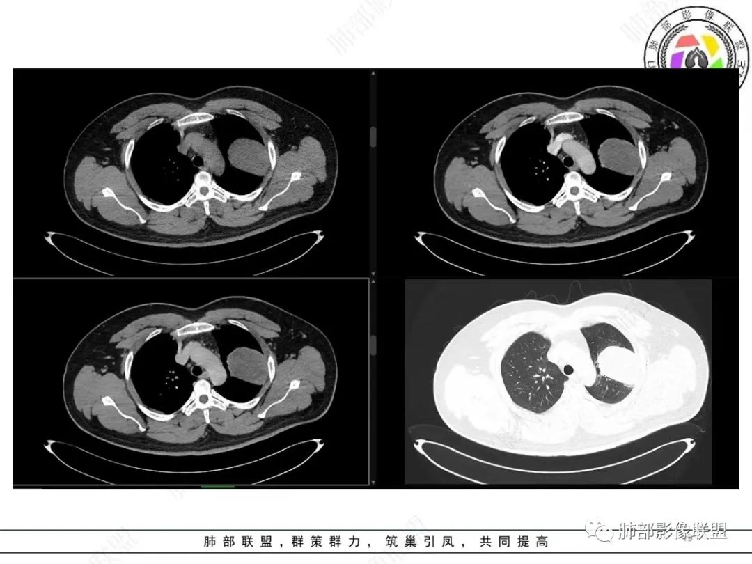 影像PPT - 【病例】左上胸骨外尤文氏肉瘤1例CT影像-20 影像PPT - 【病例】左上胸骨外尤文氏肉瘤1例CT影像-20