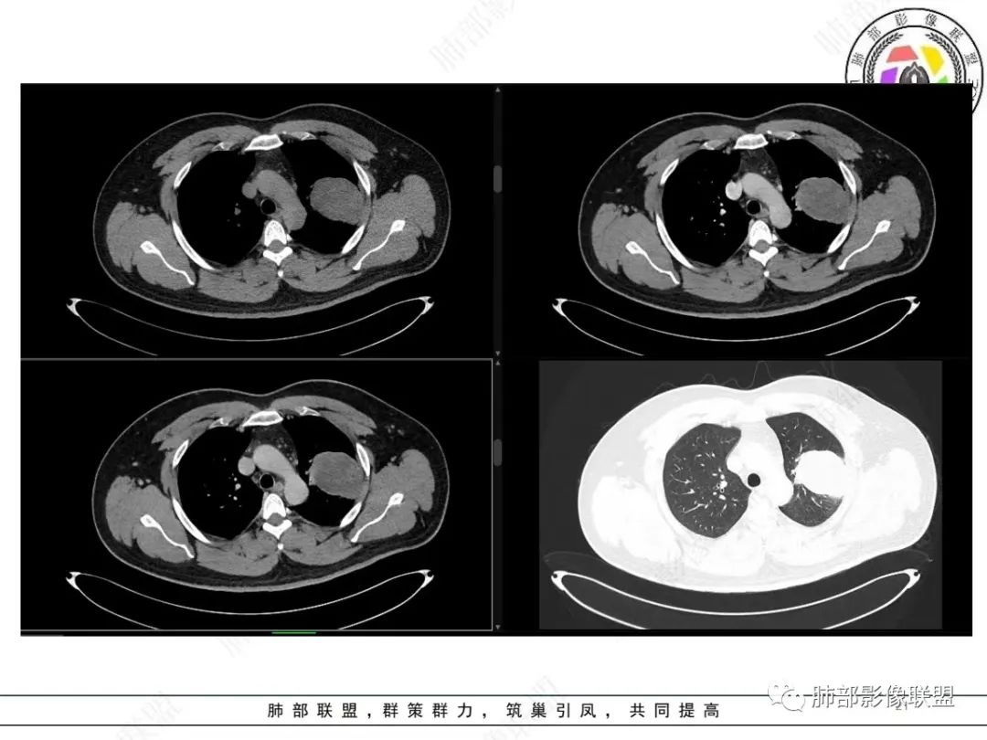 影像PPT - 【病例】左上胸骨外尤文氏肉瘤1例CT影像-21 影像PPT - 【病例】左上胸骨外尤文氏肉瘤1例CT影像-21