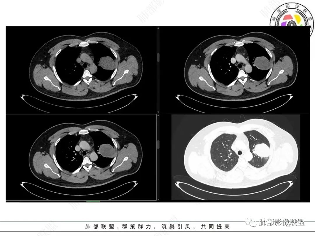 影像PPT - 【病例】左上胸骨外尤文氏肉瘤1例CT影像-23 影像PPT - 【病例】左上胸骨外尤文氏肉瘤1例CT影像-23