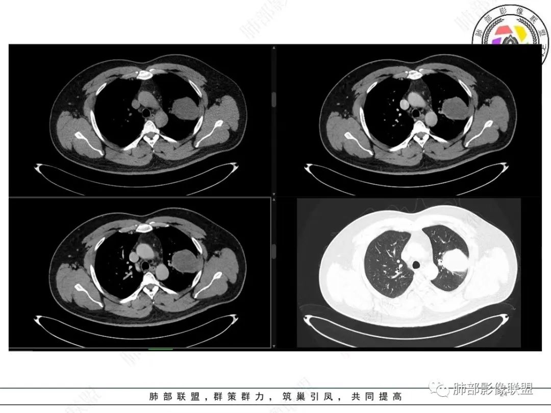 影像PPT - 【病例】左上胸骨外尤文氏肉瘤1例CT影像-24 影像PPT - 【病例】左上胸骨外尤文氏肉瘤1例CT影像-24