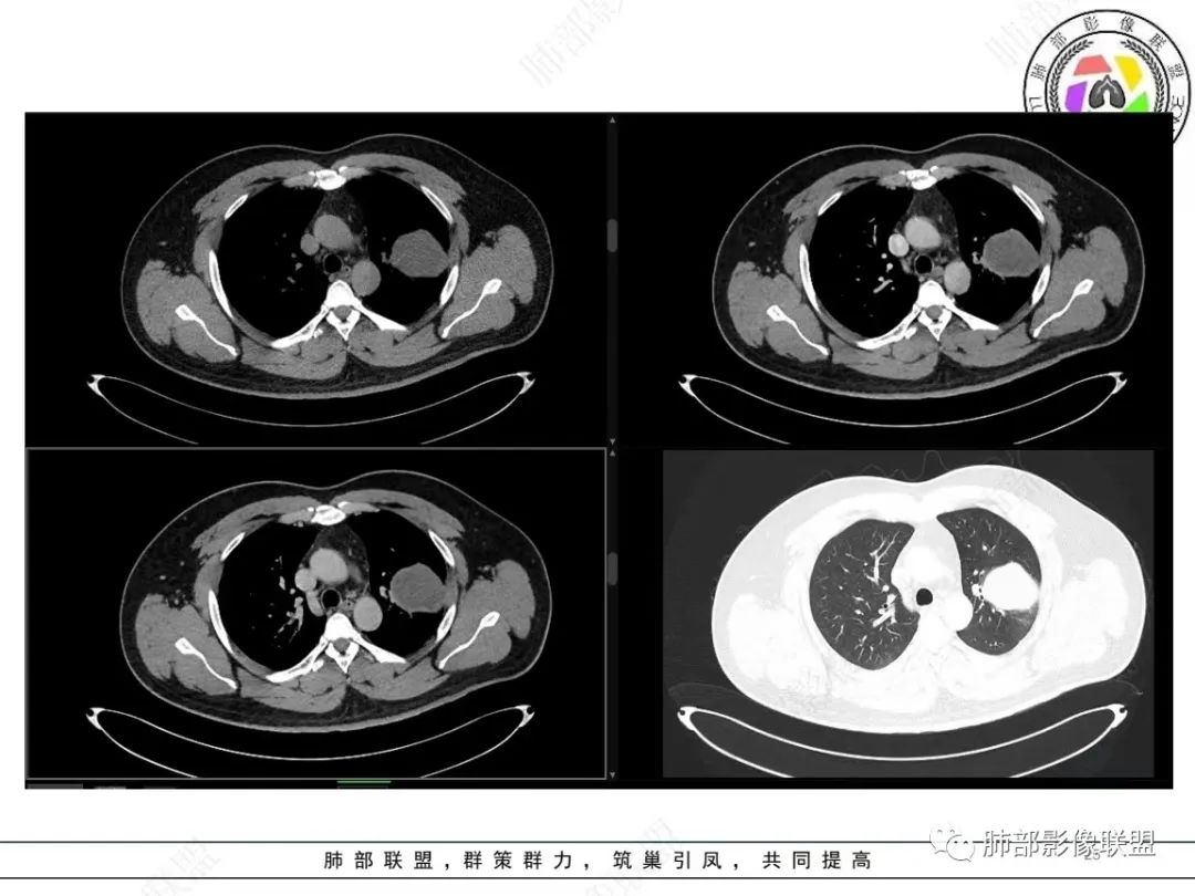 影像PPT - 【病例】左上胸骨外尤文氏肉瘤1例CT影像-25 影像PPT - 【病例】左上胸骨外尤文氏肉瘤1例CT影像-25