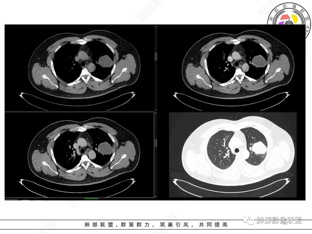 影像PPT - 【病例】左上胸骨外尤文氏肉瘤1例CT影像-26 影像PPT - 【病例】左上胸骨外尤文氏肉瘤1例CT影像-26
