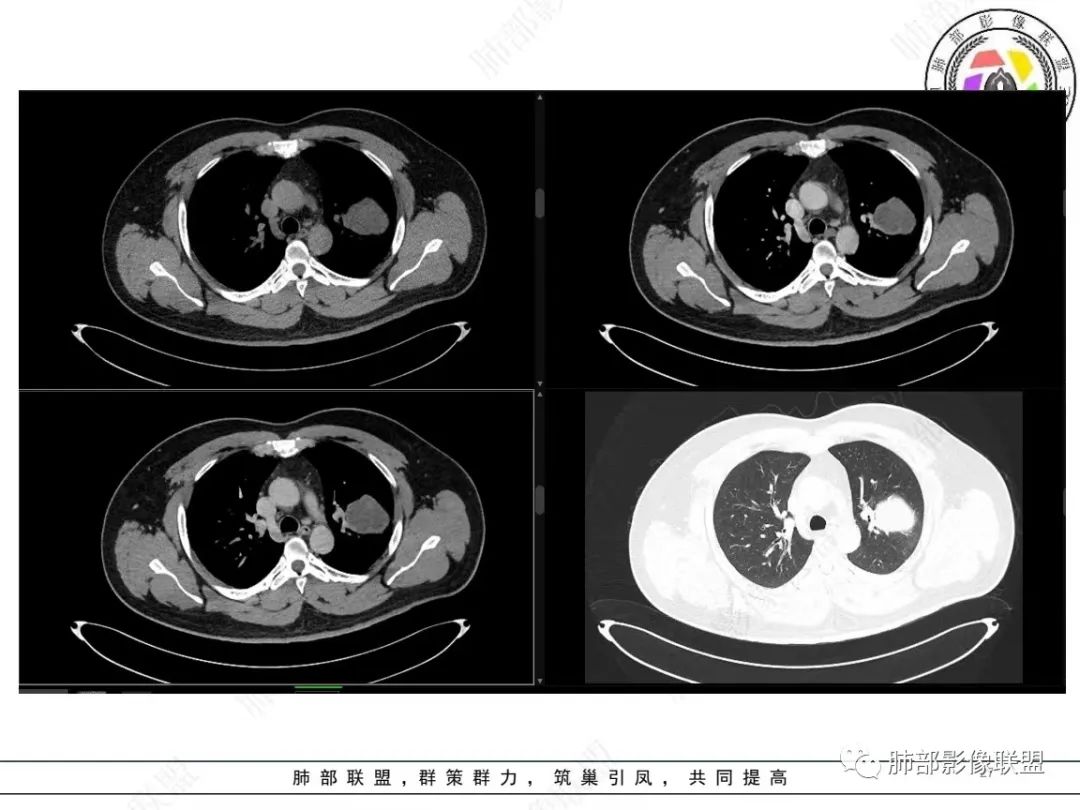 影像PPT - 【病例】左上胸骨外尤文氏肉瘤1例CT影像-27 影像PPT - 【病例】左上胸骨外尤文氏肉瘤1例CT影像-27