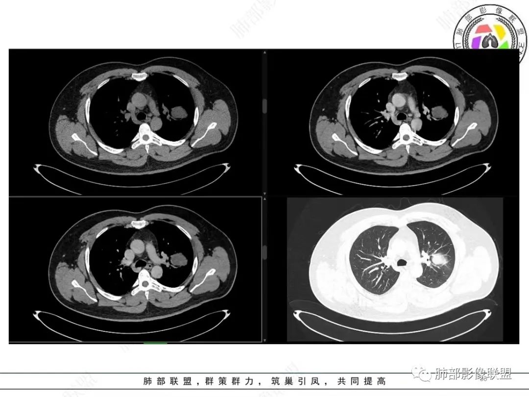 影像PPT - 【病例】左上胸骨外尤文氏肉瘤1例CT影像-30 影像PPT - 【病例】左上胸骨外尤文氏肉瘤1例CT影像-30