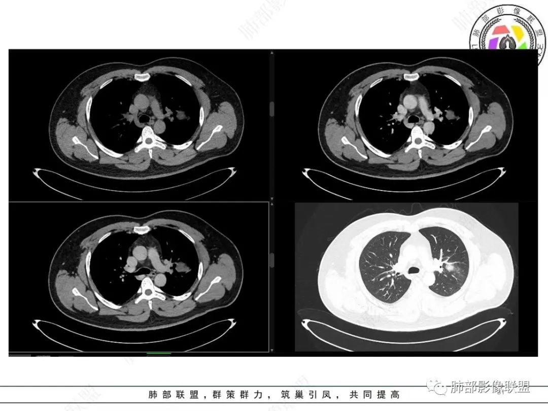 影像PPT - 【病例】左上胸骨外尤文氏肉瘤1例CT影像-31 影像PPT - 【病例】左上胸骨外尤文氏肉瘤1例CT影像-31