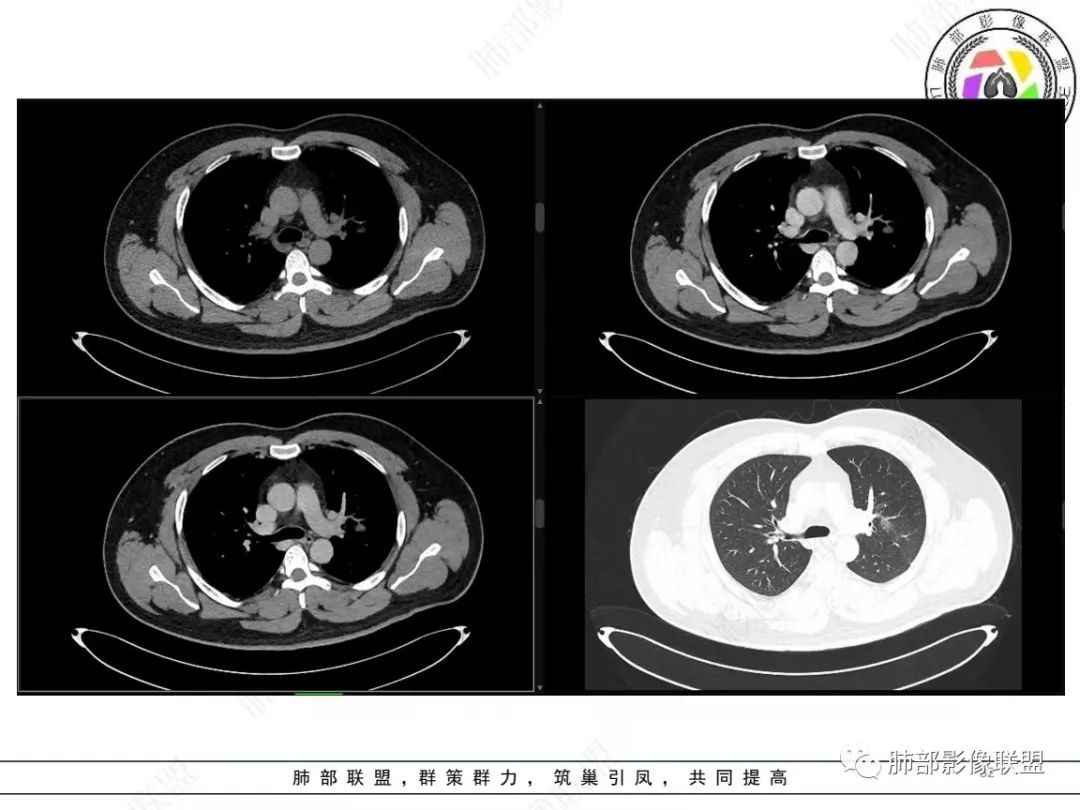 影像PPT - 【病例】左上胸骨外尤文氏肉瘤1例CT影像-32 影像PPT - 【病例】左上胸骨外尤文氏肉瘤1例CT影像-32
