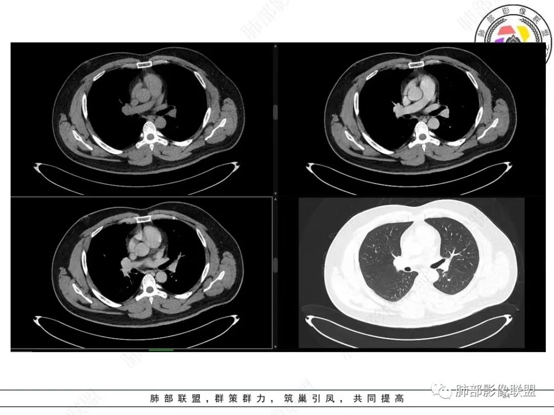 影像PPT - 【病例】左上胸骨外尤文氏肉瘤1例CT影像-33 影像PPT - 【病例】左上胸骨外尤文氏肉瘤1例CT影像-33