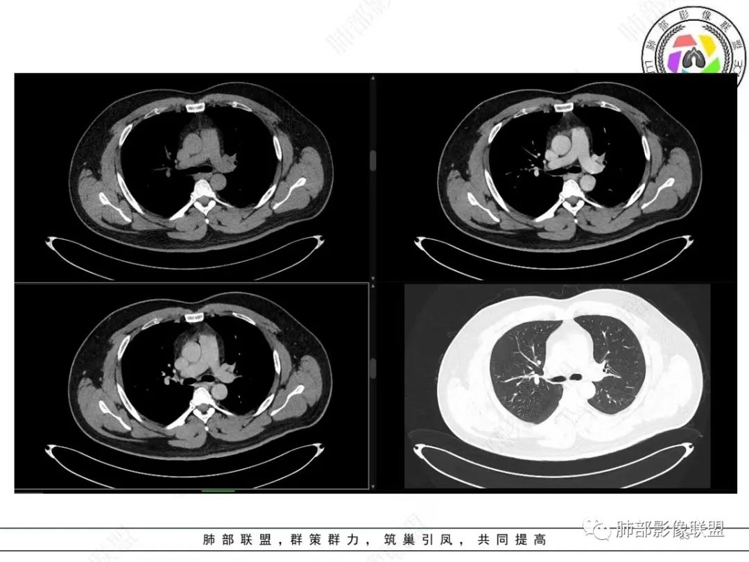影像PPT - 【病例】左上胸骨外尤文氏肉瘤1例CT影像-34 影像PPT - 【病例】左上胸骨外尤文氏肉瘤1例CT影像-34