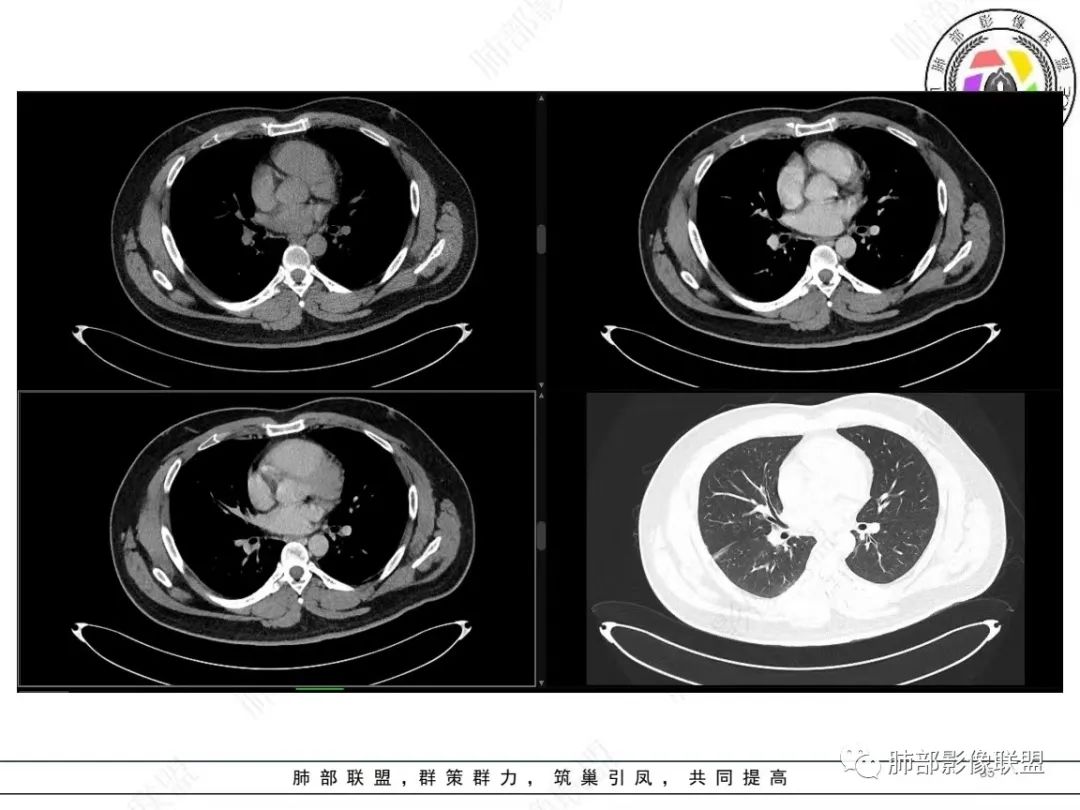 影像PPT - 【病例】左上胸骨外尤文氏肉瘤1例CT影像-35 影像PPT - 【病例】左上胸骨外尤文氏肉瘤1例CT影像-35