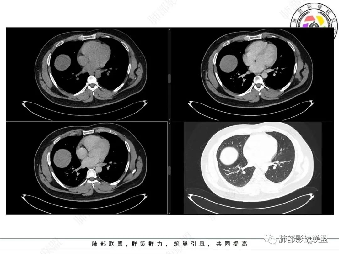 影像PPT - 【病例】左上胸骨外尤文氏肉瘤1例CT影像-36 影像PPT - 【病例】左上胸骨外尤文氏肉瘤1例CT影像-36