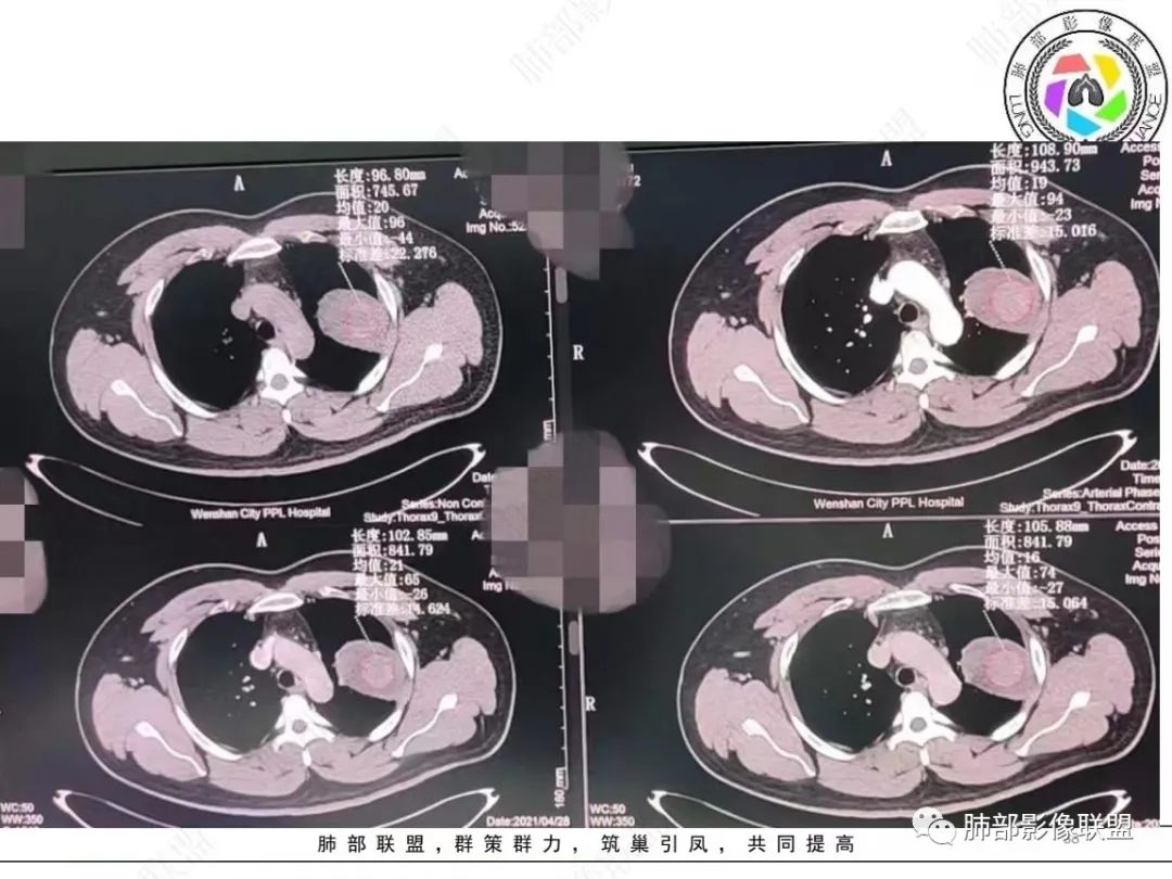 影像PPT - 【病例】左上胸骨外尤文氏肉瘤1例CT影像-38 影像PPT - 【病例】左上胸骨外尤文氏肉瘤1例CT影像-38