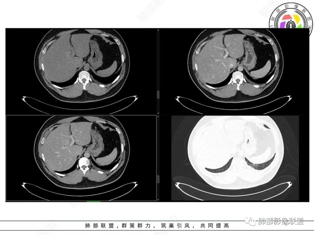 影像PPT - 【病例】左上胸骨外尤文氏肉瘤1例CT影像-37 影像PPT - 【病例】左上胸骨外尤文氏肉瘤1例CT影像-37