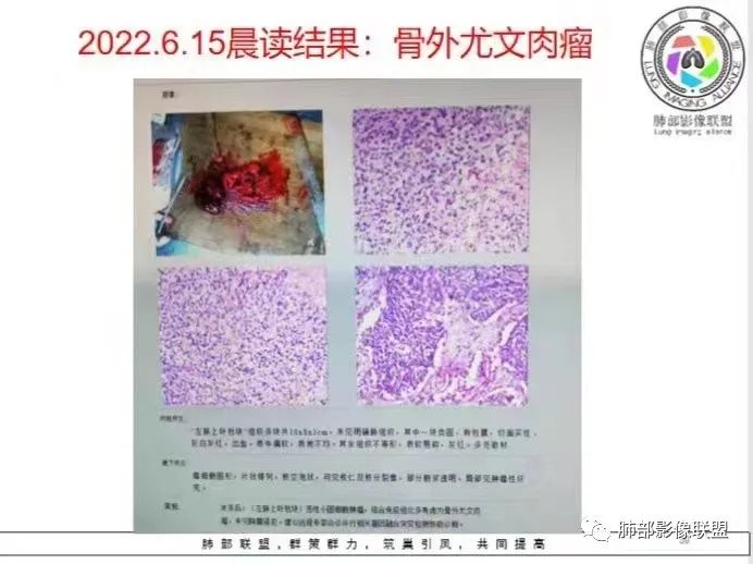 影像PPT - 【病例】左上胸骨外尤文氏肉瘤1例CT影像-43 影像PPT - 【病例】左上胸骨外尤文氏肉瘤1例CT影像-43