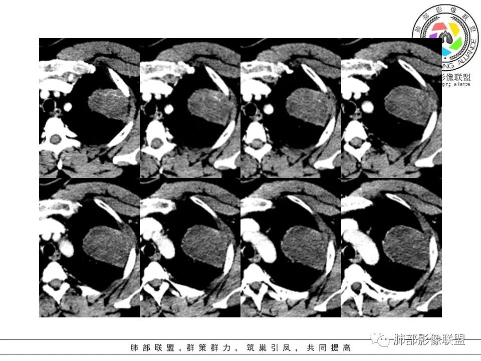 影像PPT - 【病例】左上胸骨外尤文氏肉瘤1例CT影像-44 影像PPT - 【病例】左上胸骨外尤文氏肉瘤1例CT影像-44