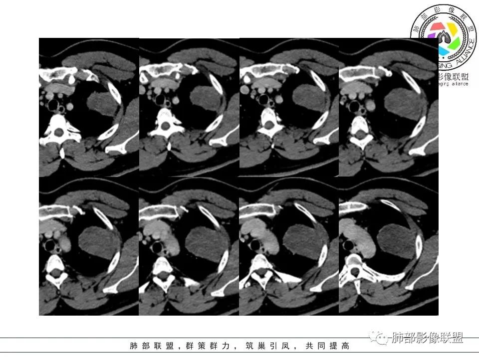 影像PPT - 【病例】左上胸骨外尤文氏肉瘤1例CT影像-45 影像PPT - 【病例】左上胸骨外尤文氏肉瘤1例CT影像-45