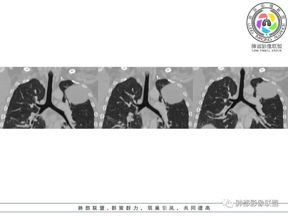 影像PPT - 【病例】左上胸骨外尤文氏肉瘤1例CT影像-47 影像PPT - 【病例】左上胸骨外尤文氏肉瘤1例CT影像-47