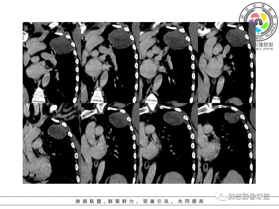 影像PPT - 【病例】左上胸骨外尤文氏肉瘤1例CT影像-48 影像PPT - 【病例】左上胸骨外尤文氏肉瘤1例CT影像-48